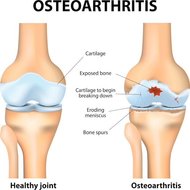 What Are The Symptoms And Treatments For Osteoarthritis 